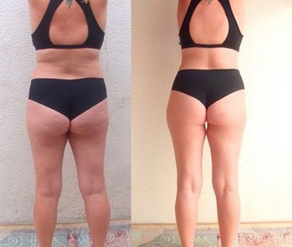 Душ Шарко для похудения — фото до и после